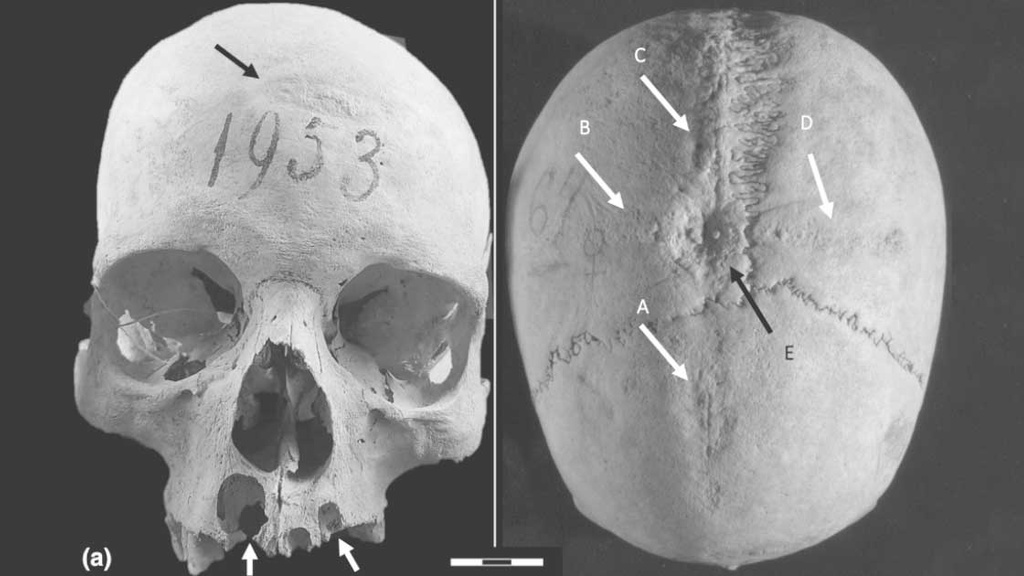 Medieval Skull Surgery